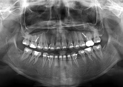 Jaw full 3